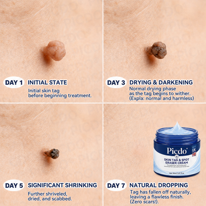 𝐏𝐢𝐜𝐝𝐨® 7-𝐃𝐚𝐲 𝐒𝐤𝐢𝐧 𝐓𝐚𝐠 & 𝐒𝐩𝐨𝐭 𝐄𝐫𝐚𝐬𝐞𝐫 𝐂𝐫𝐞𝐚𝐦🩵(Zero Pain, Zero 𝐒𝐜𝐚𝐫𝐬 Formula)🚀