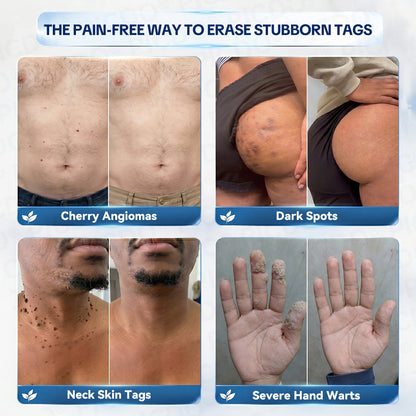 𝐏𝐢𝐜𝐝𝐨® 7-𝐃𝐚𝐲 𝐒𝐤𝐢𝐧 𝐓𝐚𝐠 & 𝐒𝐩𝐨𝐭 𝐄𝐫𝐚𝐬𝐞𝐫 𝐂𝐫𝐞𝐚𝐦🩵(Zero Pain, Zero 𝐒𝐜𝐚𝐫𝐬 Formula)🍁