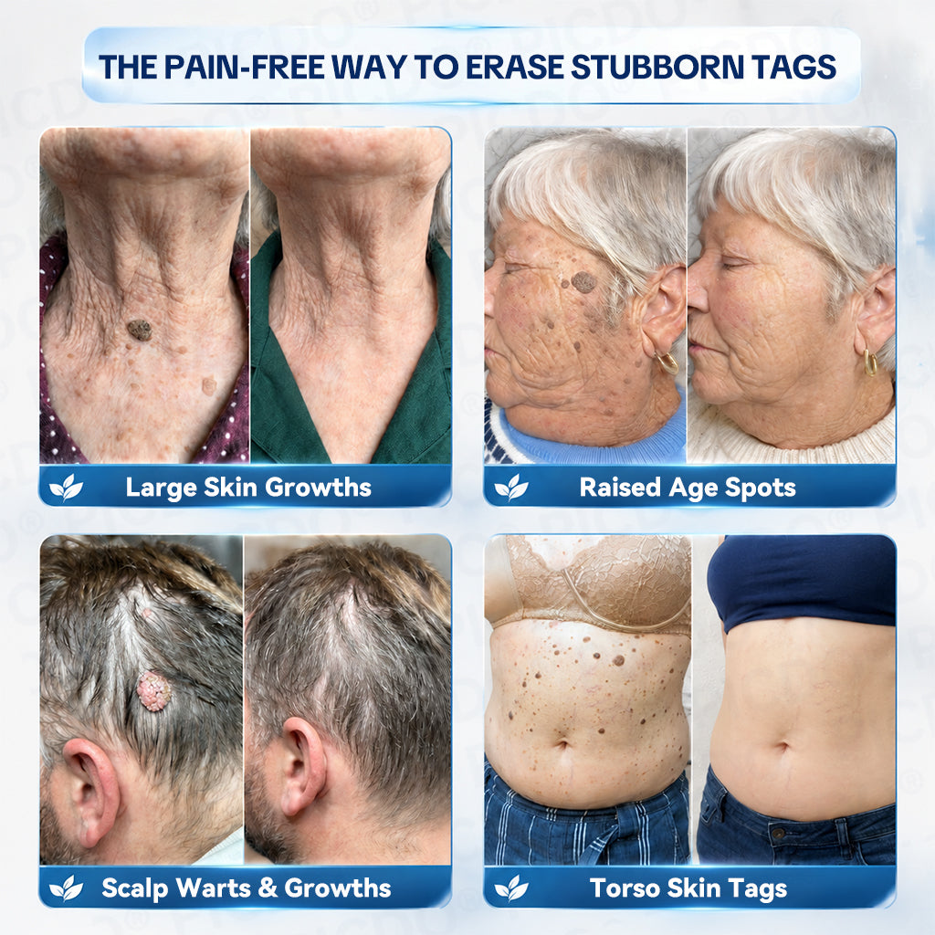 𝐏𝐢𝐜𝐝𝐨® 7-𝐃𝐚𝐲 𝐒𝐤𝐢𝐧 𝐓𝐚𝐠 & 𝐒𝐩𝐨𝐭 𝐄𝐫𝐚𝐬𝐞𝐫 𝐂𝐫𝐞𝐚𝐦🩵(Zero Pain, Zero 𝐒𝐜𝐚𝐫𝐬 Formula)🎉