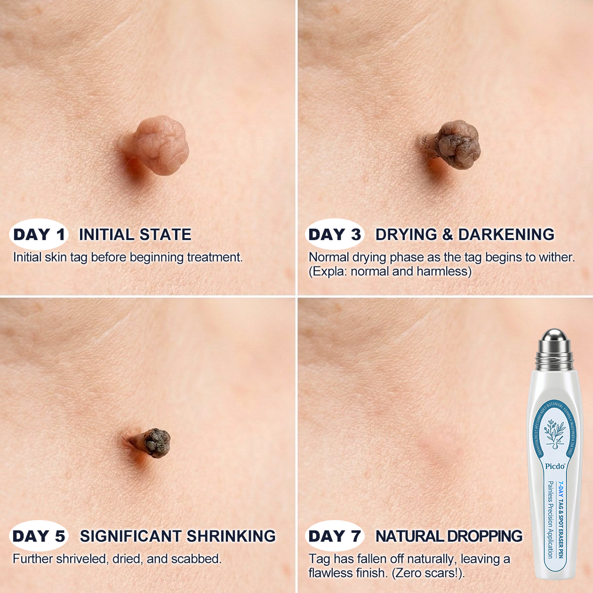 𝐏i𝐜𝐝o®🎉🎉7-𝐷𝑎𝑦 𝗧𝐚𝐠 & 𝗦𝗽𝐨𝐭 𝐄𝐫𝒂𝒔𝒆𝒓(Zero Pain, Zero 𝐒𝐜𝐚𝒓𝒔 Rollerball)